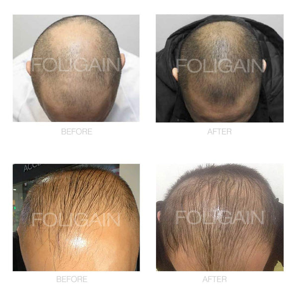 FOLIGAIN Canada Men's Hair Regrowth Kit with TRIOXIDIL 10% and Minoxidil 5%, showing before and after hair improvement images