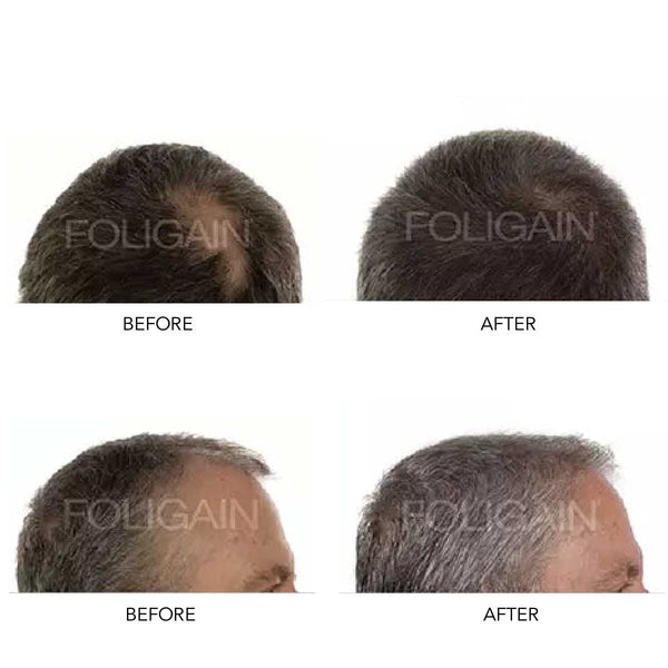 Before and after images of FOLIGAIN Men's Hair Regrowth Kit with TRIOXIDIL 10% and Minoxidil 5% showing hair improvements