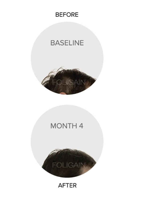 FOLIGAIN Triple Action Complete Formula For Thinning Hair For Women with 10% Trioxidil - FOLIGAIN CANADA