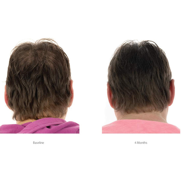 FOLIGAIN Women's Hair Regrowth Kit with TRIOXIDIL and 2% Minoxidil, featuring hair treatment products for women.