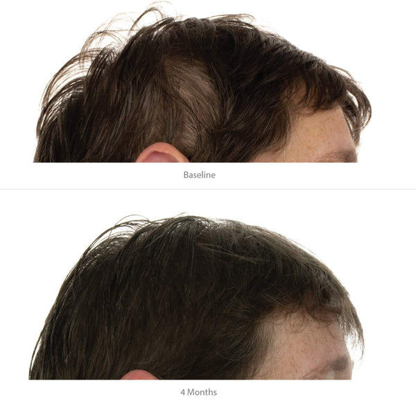 FOLIGAIN Women's Hair Regrowth Kit with TRIOXIDIL and Minoxidil 2% for hair thinning and revitalization, shown with hair care products.